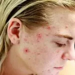 Come sconfiggere l’acne con il derma roller