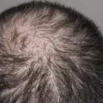 Come nascondere la calvizie: la tricopigmentazione.