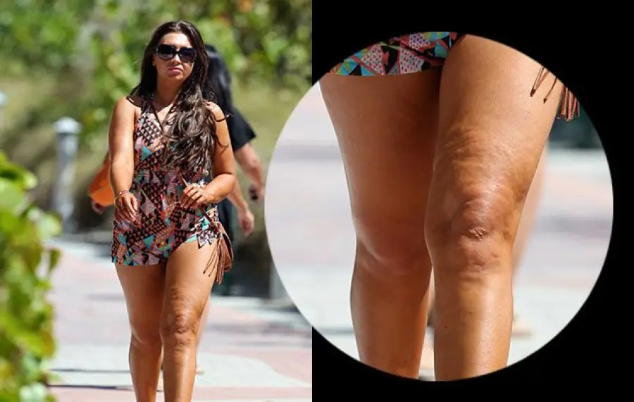 Come perdere i chili in più sulle ginocchia