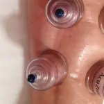 Come utilizzare la coppetta anticellulite?