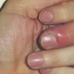 Come curare il patereccio (infezione al dito)