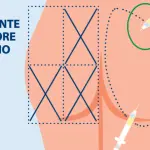 Come fare correttamente una iniezione intramuscolare