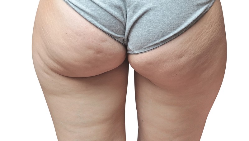 Come eliminare la cellulite in poco tempo da cosce e glutei