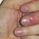 Come curare il patereccio (infezione al dito)