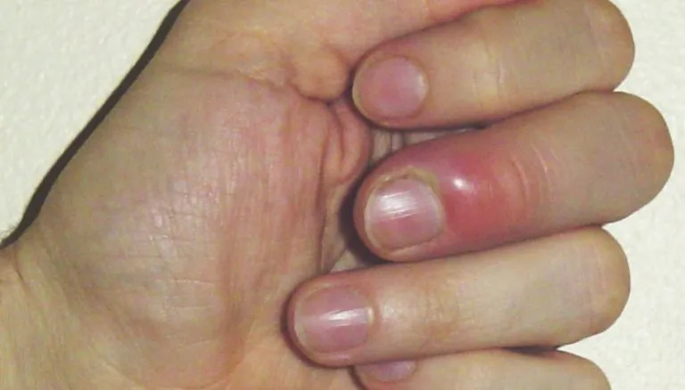 Come curare il patereccio (infezione al dito)