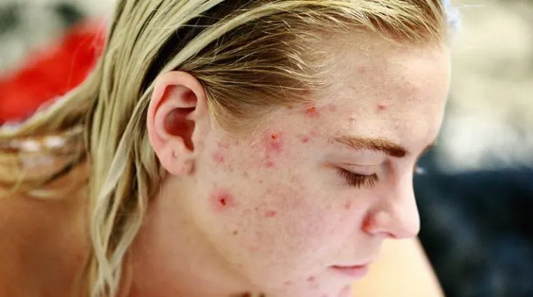 Come sconfiggere l’acne con il derma roller